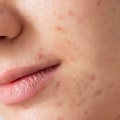 The Best Beauty and Skincare Products for Acne-Prone Skin: A Comprehensive Review