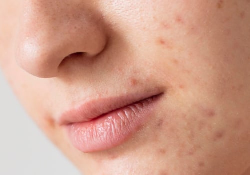 The Best Beauty and Skincare Products for Acne-Prone Skin: A Comprehensive Review